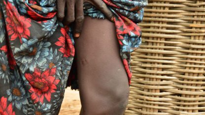 guinea worm disease