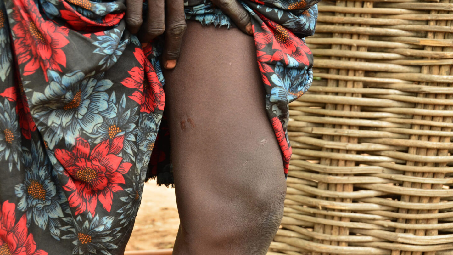 guinea worm disease